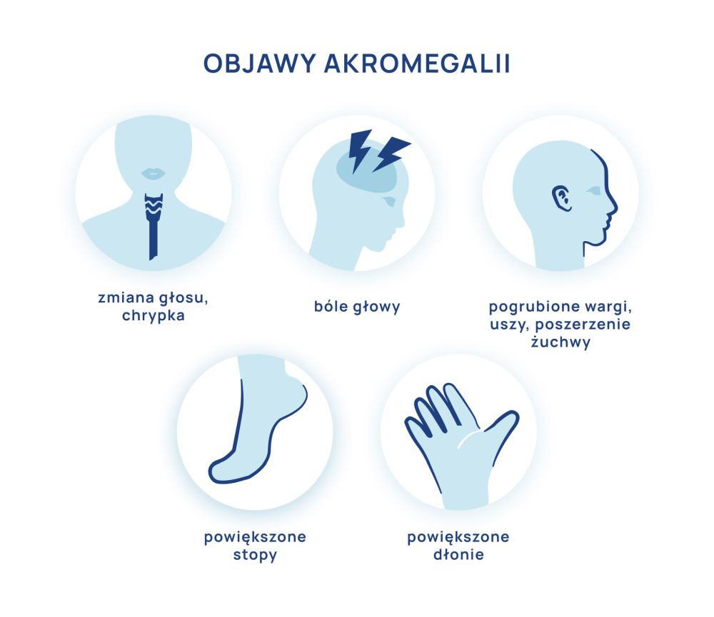 Akromegalia_infografika
