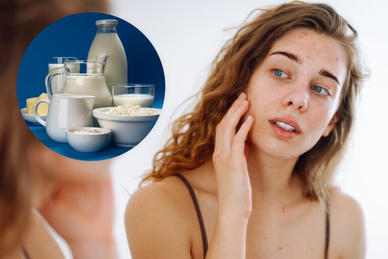 Nabiał a trądzik – fakty i mity. Jak produkty mleczne wpływają na cerę?