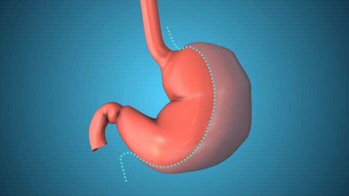 operacja bariatryczna