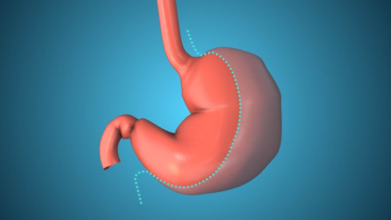 Operacja bariatryczna na czym polega i kiedy się ją wykonuje? Przygotowanie i badania