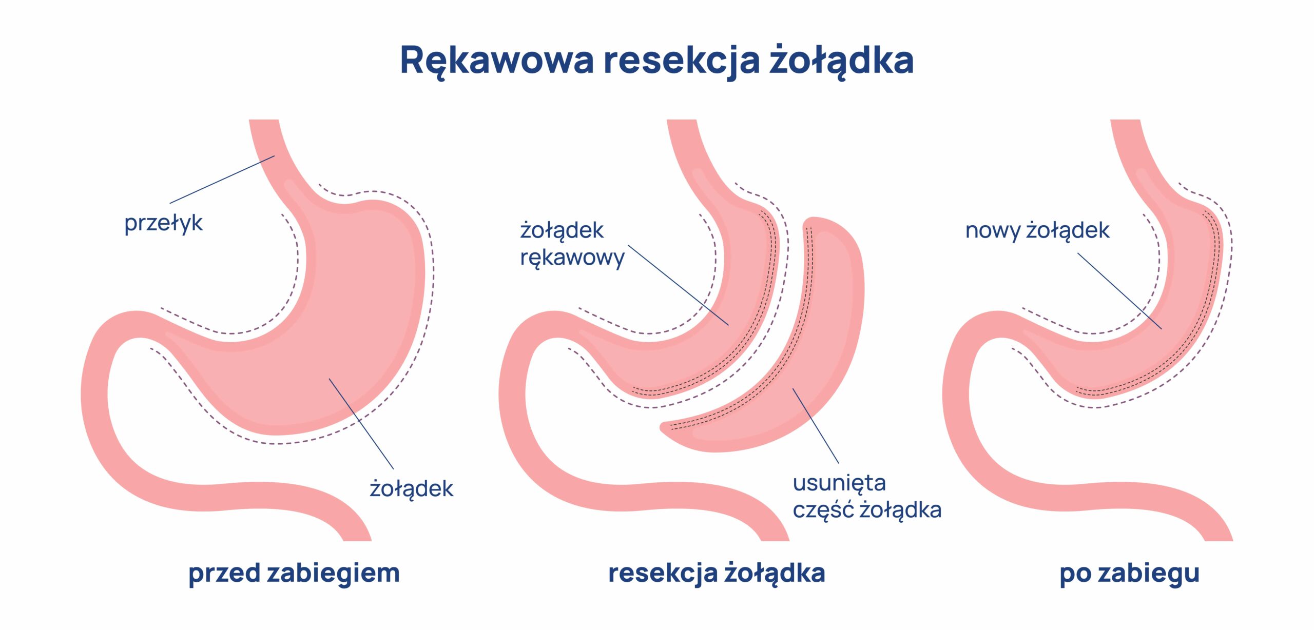 operacja bariatryczna infografika