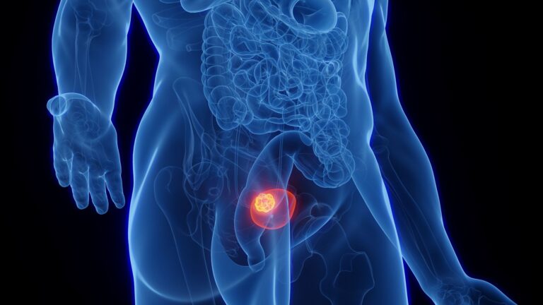 Rak pęcherza moczowego – objawy, przyczyny, diagnostyka i leczenie