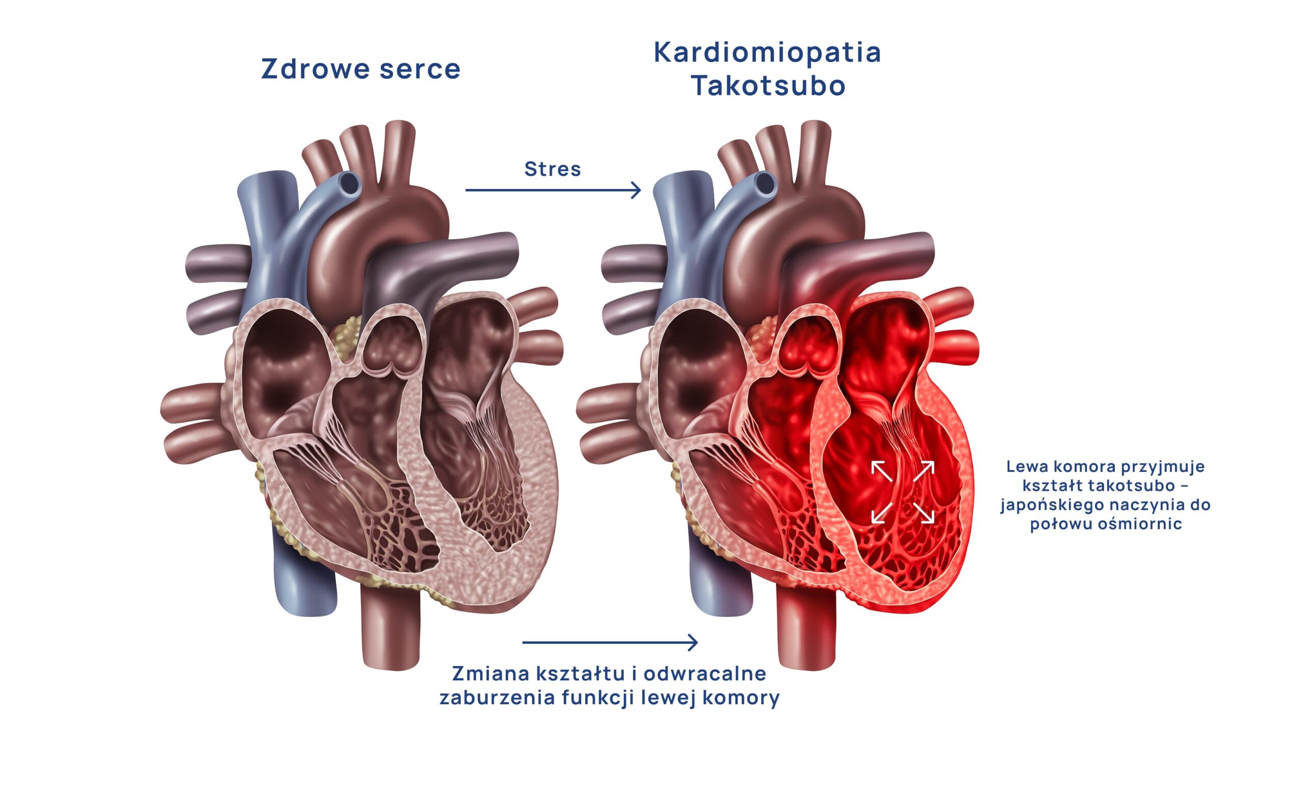 Zespol_zlamanego_serca_infografika_2