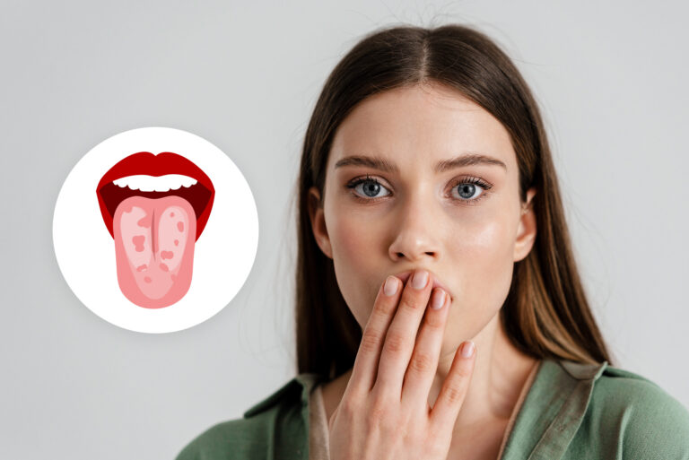 Czym jest język geograficzny? Objawy, przyczyny i leczenie