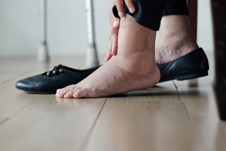 Obrzęk kostek – przyczyny, diagnostyka i leczenie