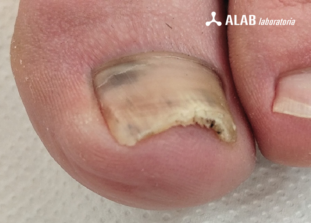 hiperkeratoza paznokcia