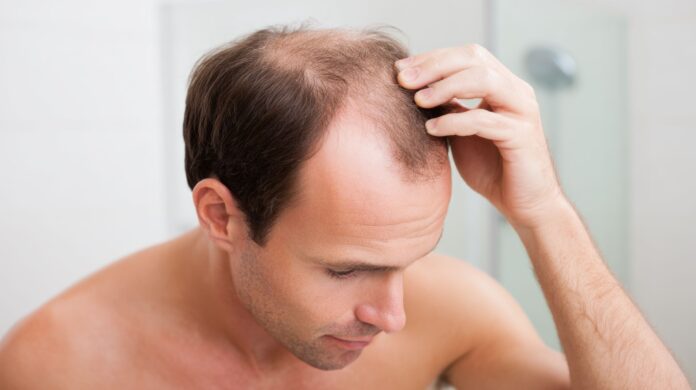 łysienie telogenowe