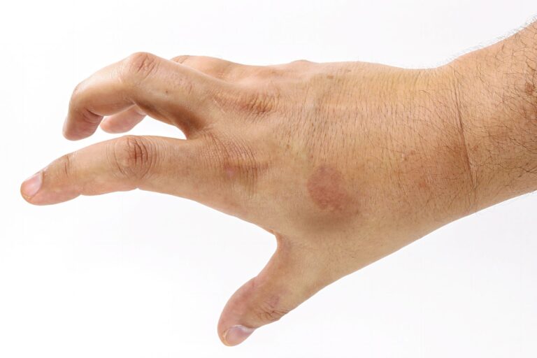 Plamy na rękach: czerwone, brązowe, białe – dlaczego powstają i co oznaczają?