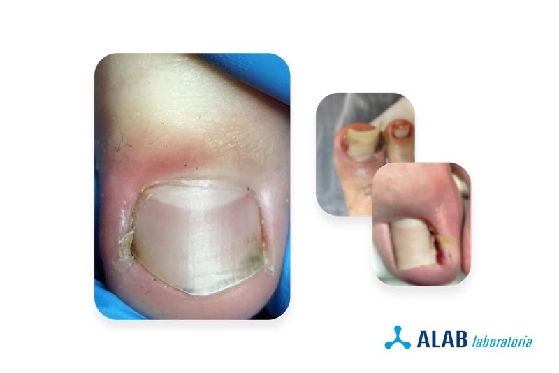 Wrastajace_paznokcie_infofrafika