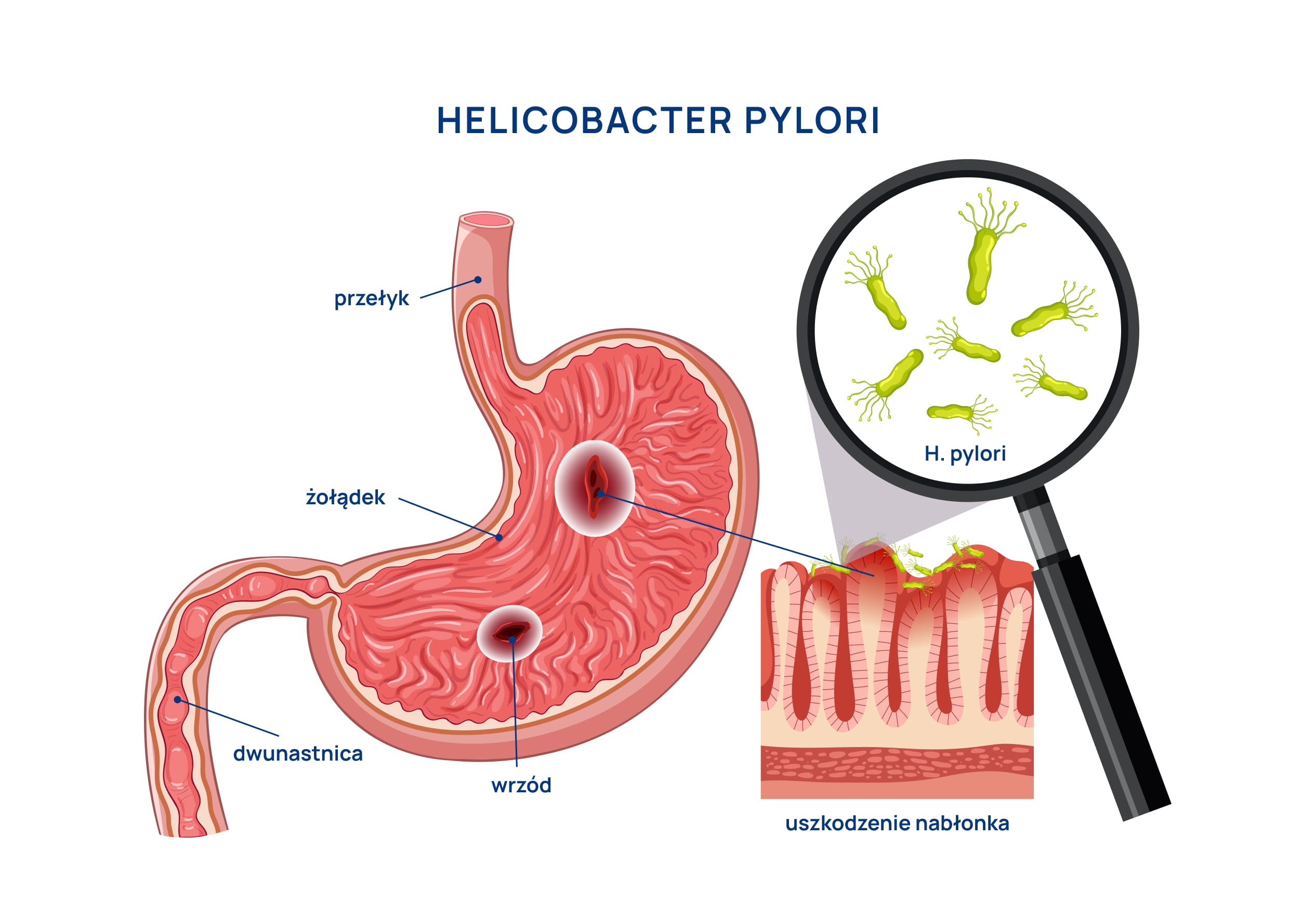 Helicobacter pylori infografika