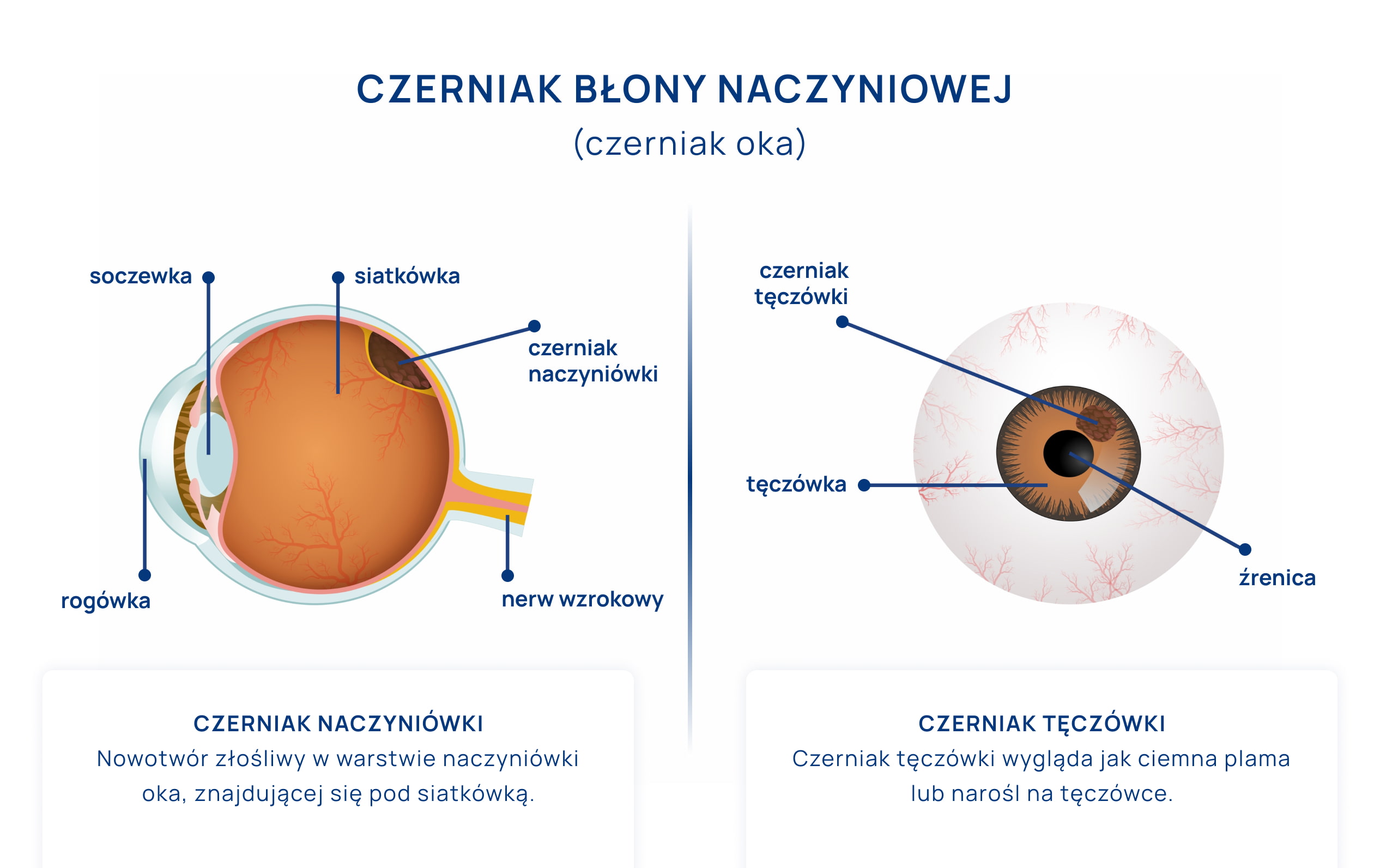 czerniak oka infografika