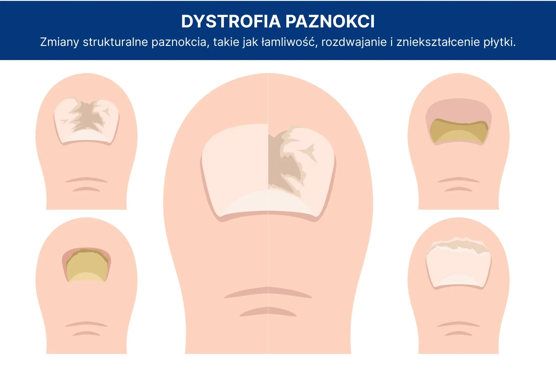 Dystrofia_paznokci_infografika