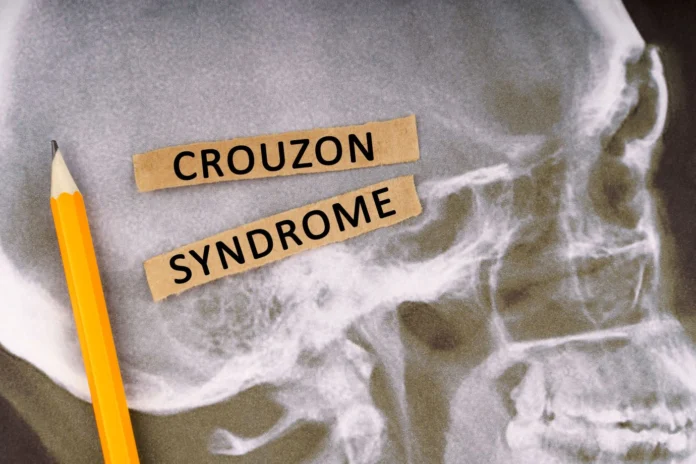 zespół_Crouzona zespół Crouzona